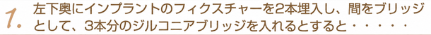 1.左下奥にインプラントのフィクスチャーを2本埋入し、間をブリッジとして、3本分のジルコニアブリッジを入れるとすると・・・